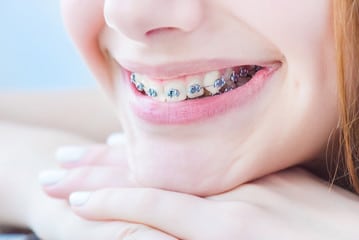 avoid bacteria while wearing braces