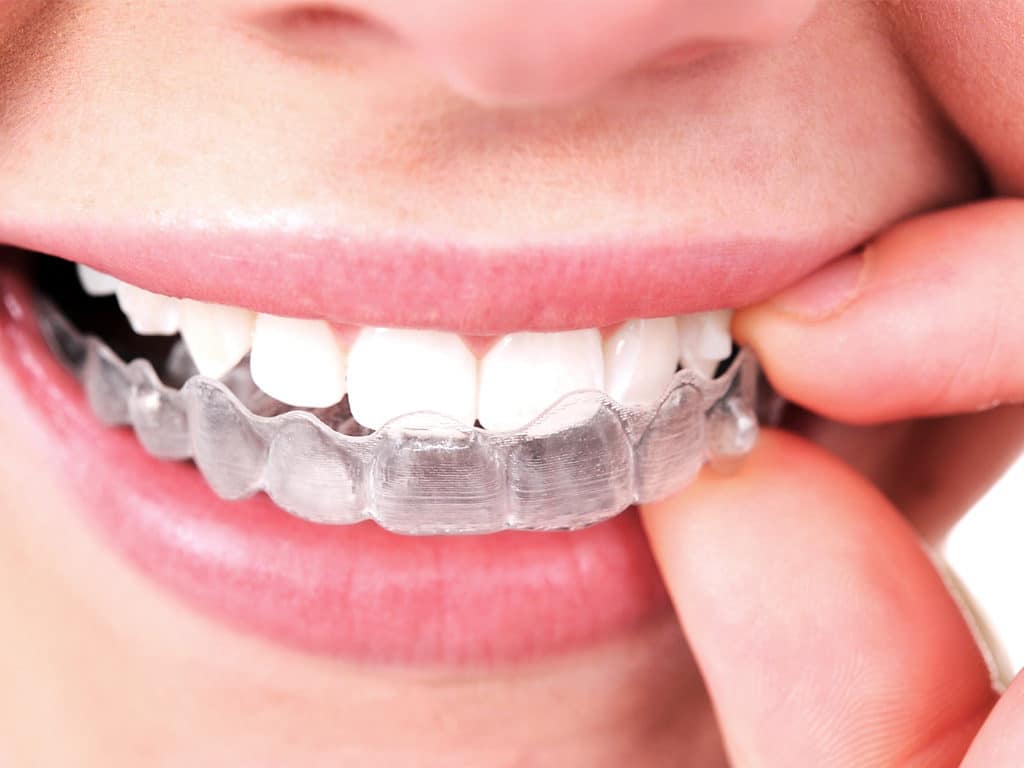 Pros and cons of Invisalign