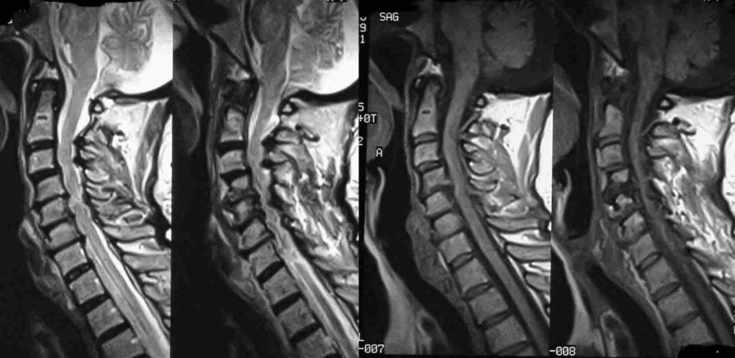 a-guide-to-central-canal-stenosis-sound-health-doctor