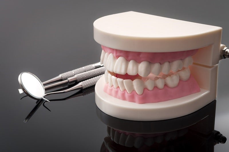 Denture implants
