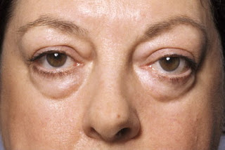 Eye bag surgery