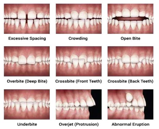 Malocclusion : Causes, Symptoms, Classification and Treatment - Sound ...