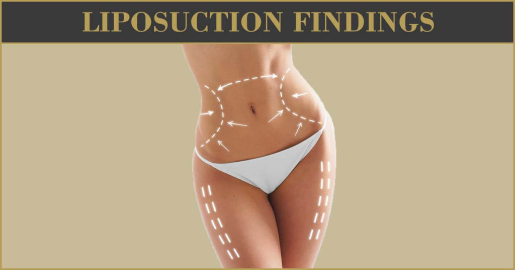 Liposuction Findings 