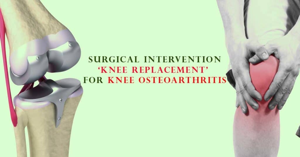 Surgical Intervention ‘Knee Replacement’ For Knee Osteoarthritis