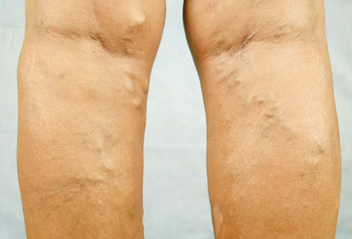 varicose vein