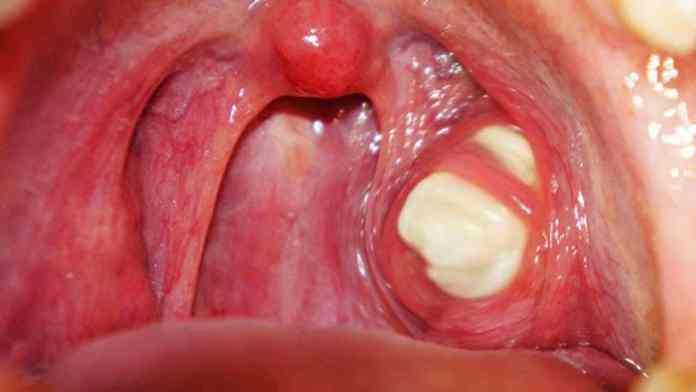 Tonsil stones