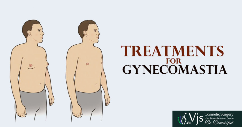 What is the bestTREATMENTS FOR GYNECOMASTIA