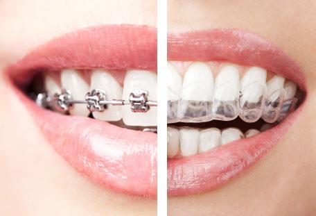 invisalign