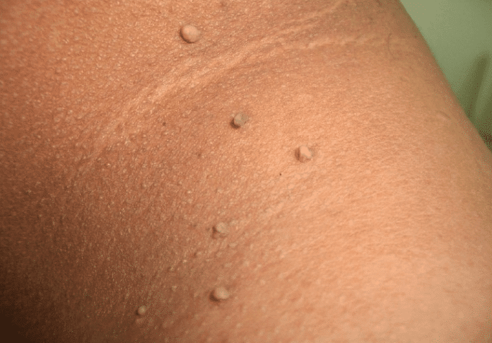 mole on skin