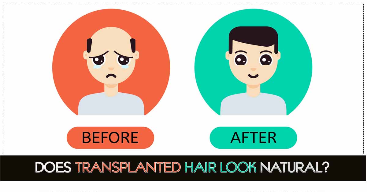 Does Transplanted Hair Look Natural