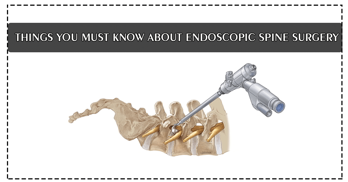 Endoscopic Spine Surgery Facts