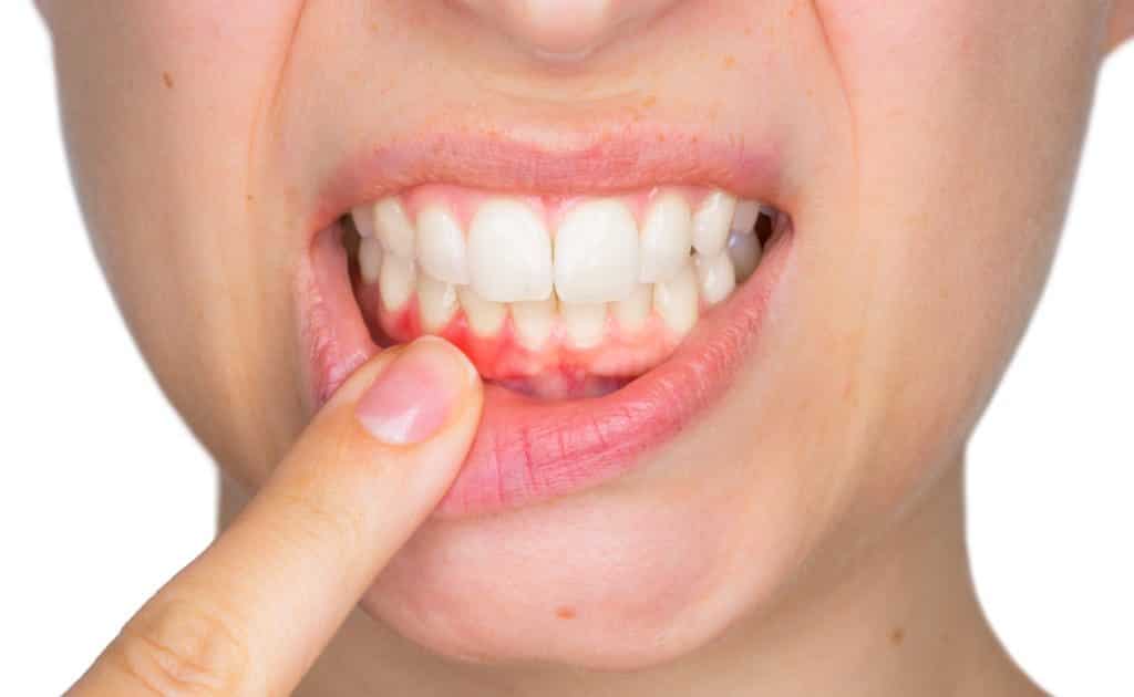Spinach juice helps reducing bleeding gums