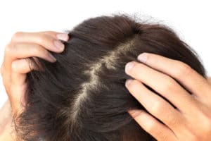 Remedies for itchy scalp