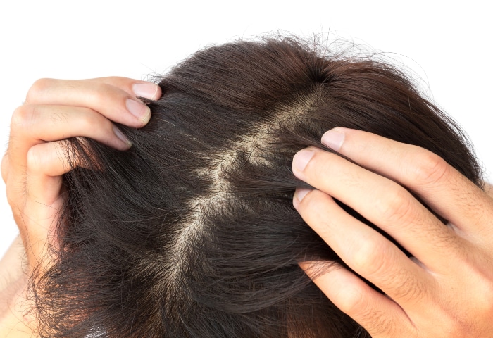 Remedies for itchy scalp