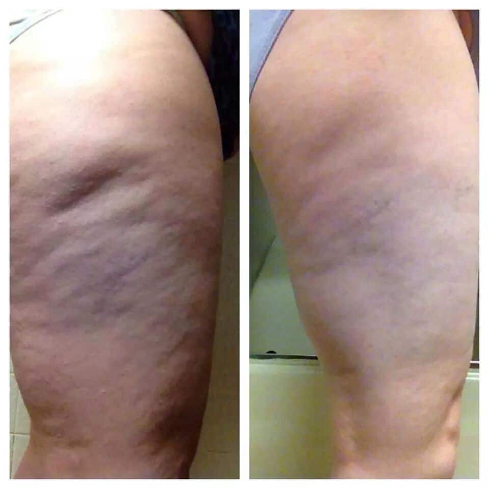 Cellulite Naturally