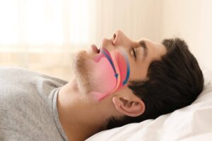 How to Silence Sleep Apnea